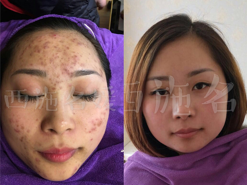 王炸新品——西施名媛/纖雅源祛痘凈顏原液，從此告別痘肌。