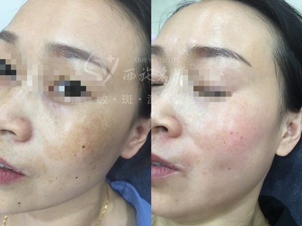 真的能行！不提取，不剝脫，涂抹就下“斑”