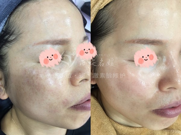 真的能行！不提取，不剝脫，涂抹就下“斑”